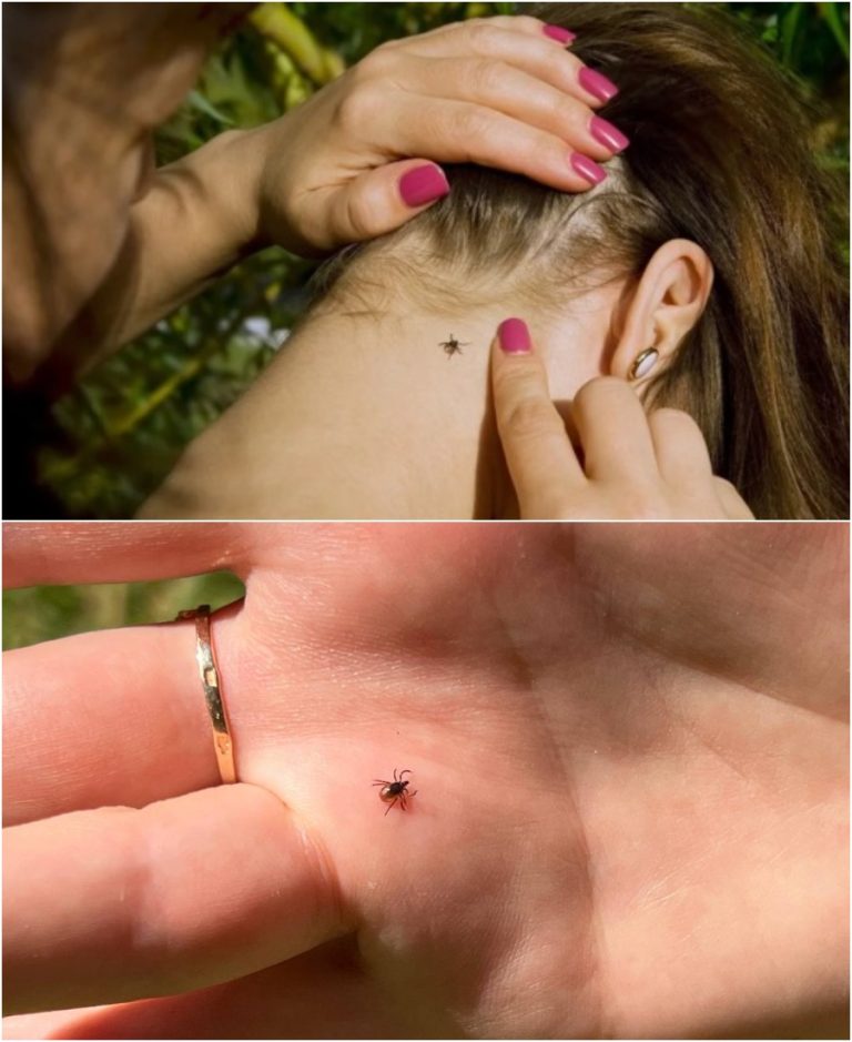 Они уже проснулись. Что нужно сразу же сделать, если вас укусил клещ